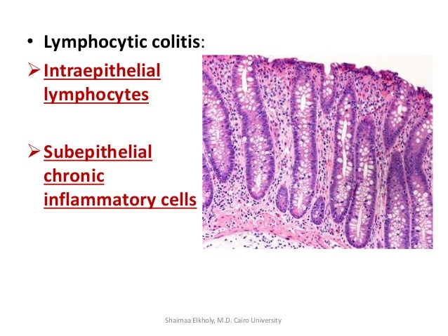 Collagenous and Lymphocytic Colitis Diagnosis at Johns Hopkins